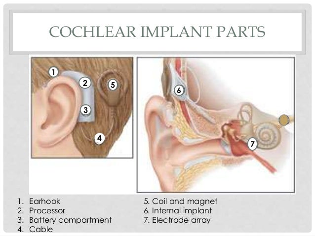 cochlear implant Adult in habilitation