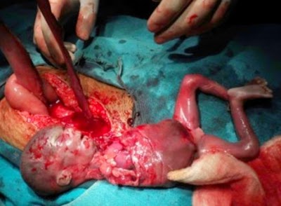 baby 24 Aborted weeks at