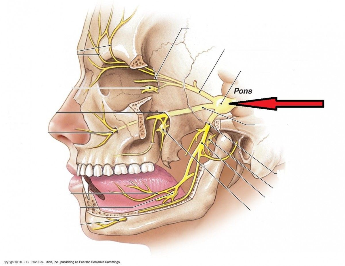 pain facial Multiple sclerosis