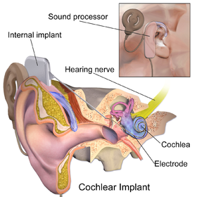 cochlear implant Adult in habilitation