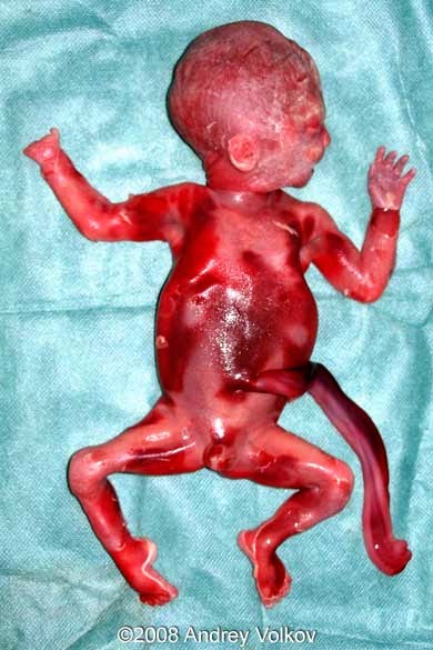 baby 24 Aborted weeks at
