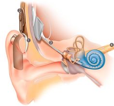 cochlear implant Adult in habilitation