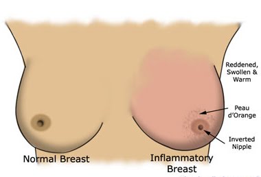 breasts 3 disease people
