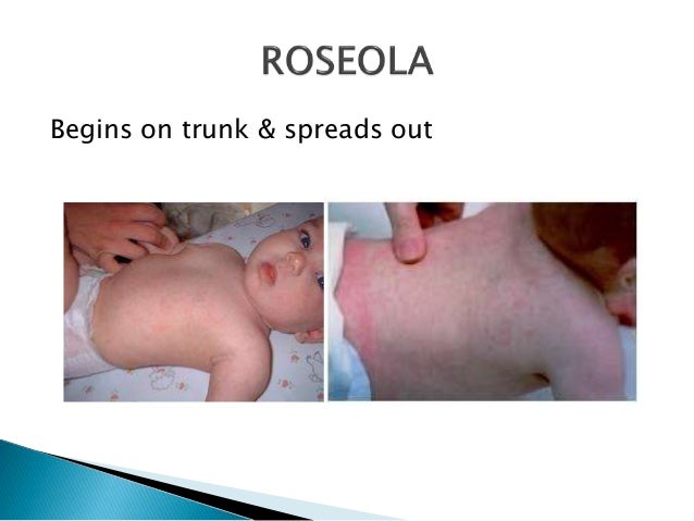 adults Roseola pregnancy in