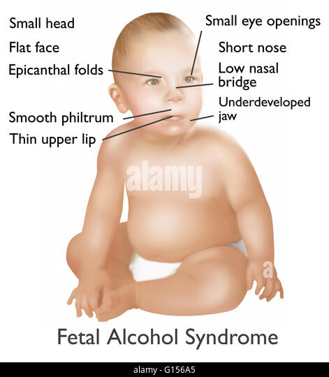 with alcohol Adult syndrome fetal
