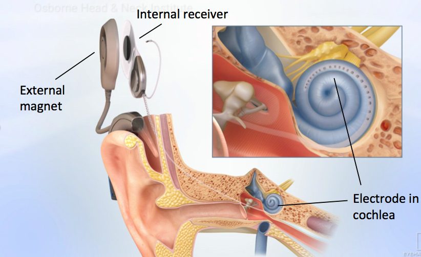 cochlear implant Adult in habilitation