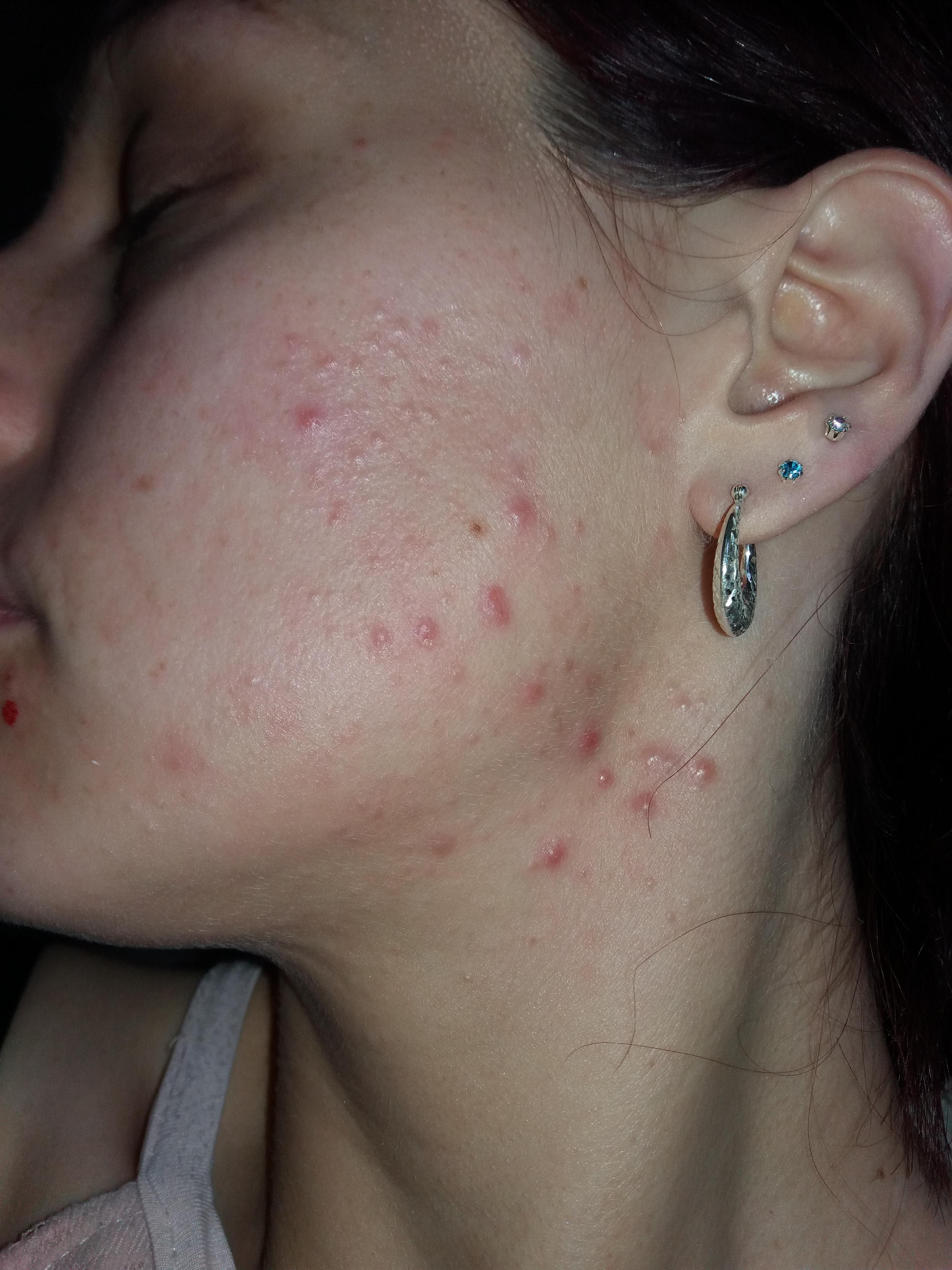 acne.ozmarketing.info adult treatment Acne