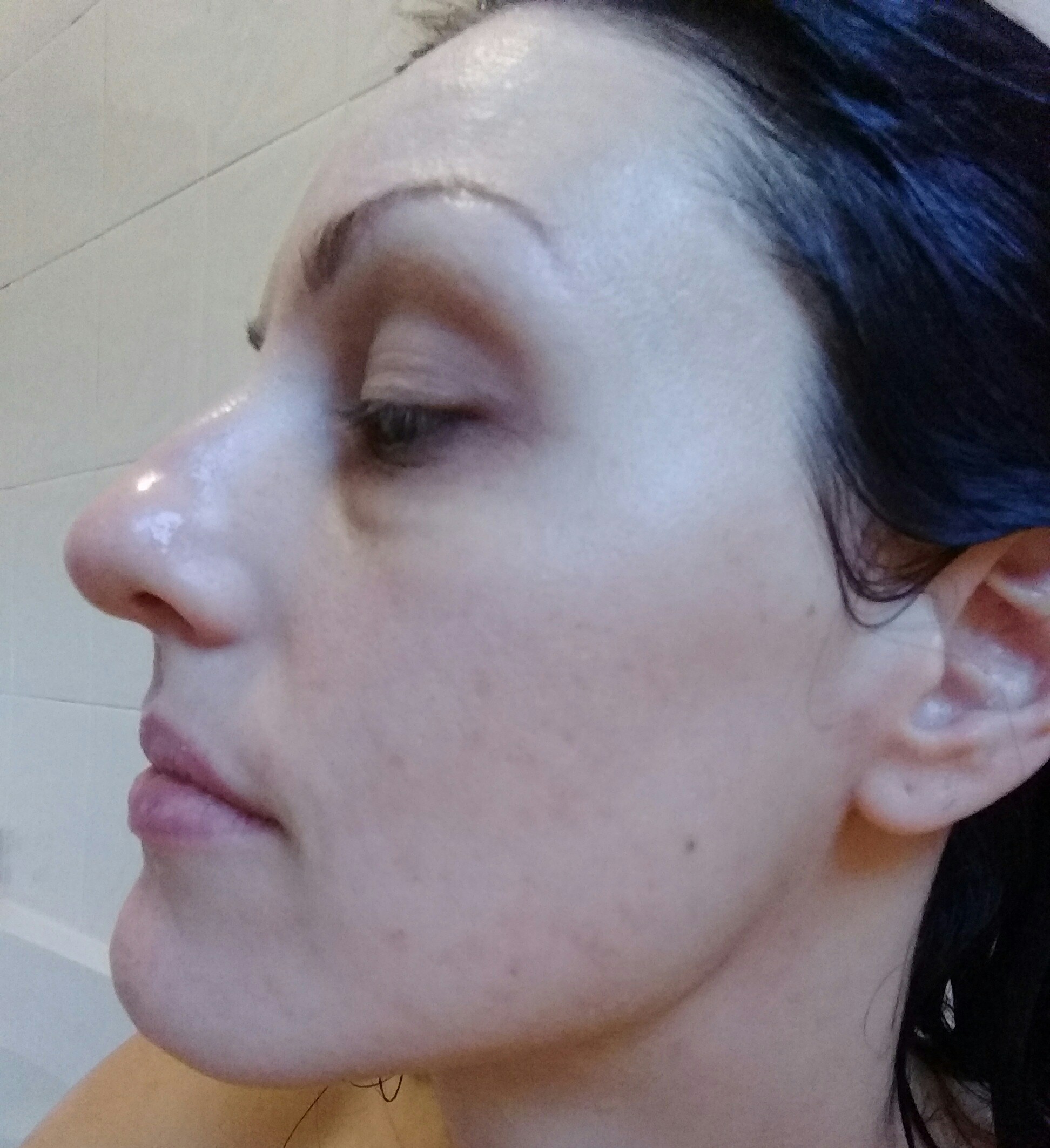adult treatment acne.ozmarketing.info Acne