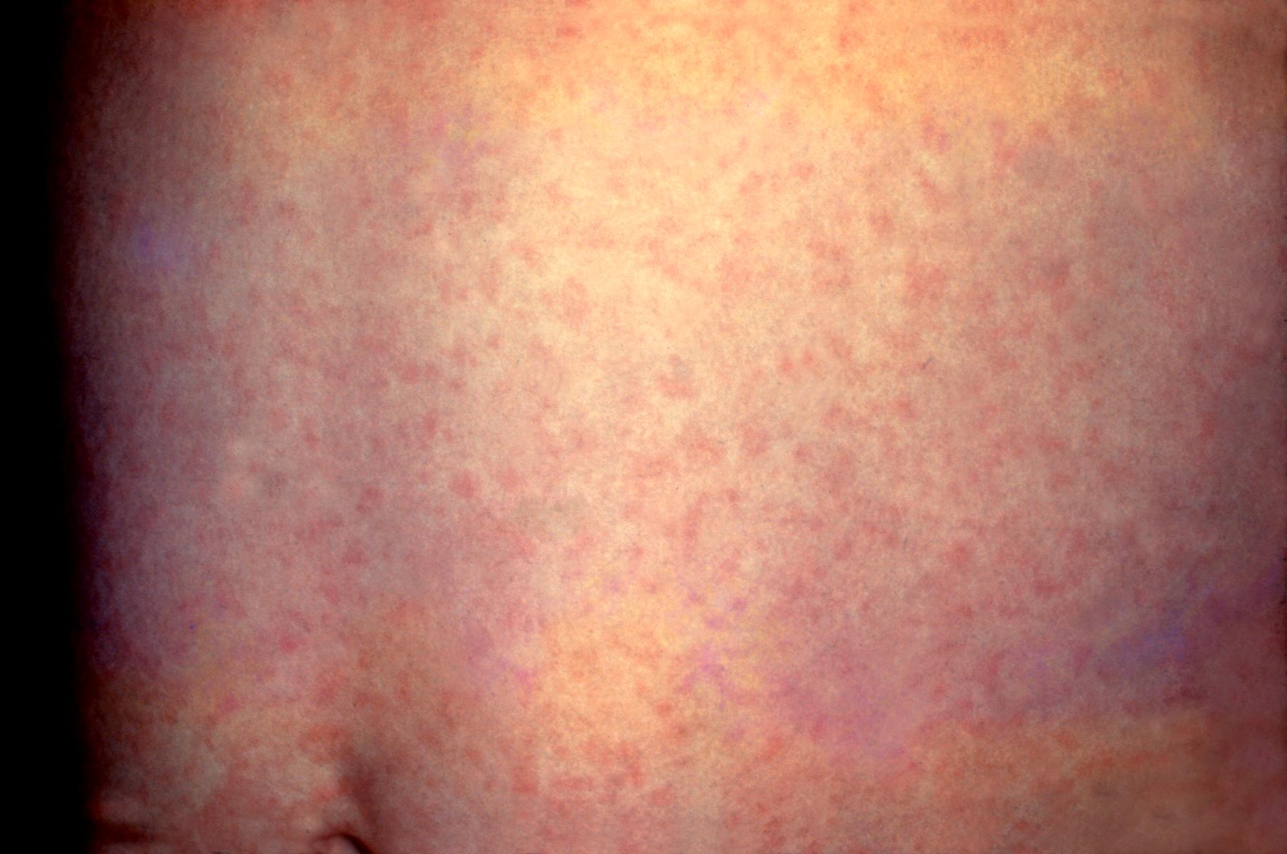in adults pregnancy Roseola
