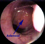 adenoids adult Enlarged