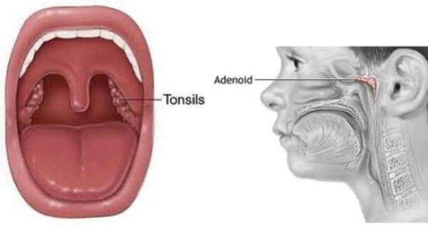 adult Enlarged adenoids