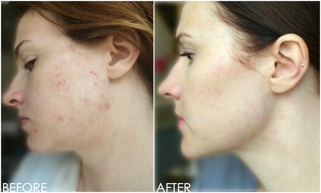 adult treatment acne.ozmarketing.info Acne