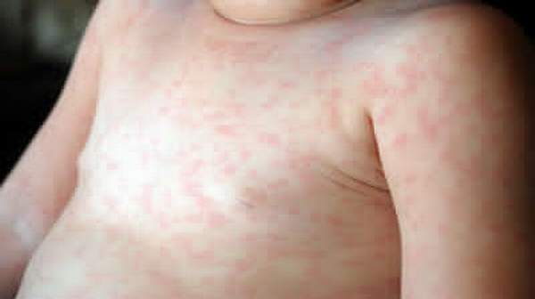 adults Roseola pregnancy in