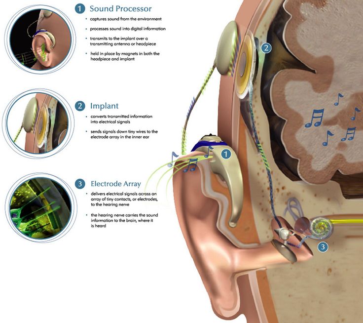 cochlear implant Adult in habilitation